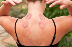 cupping 5