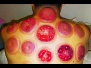 cupping 4